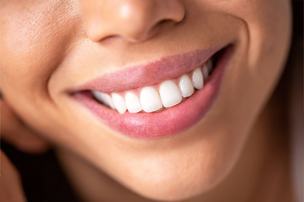 Pachet Standard – Perfect Smile Experience